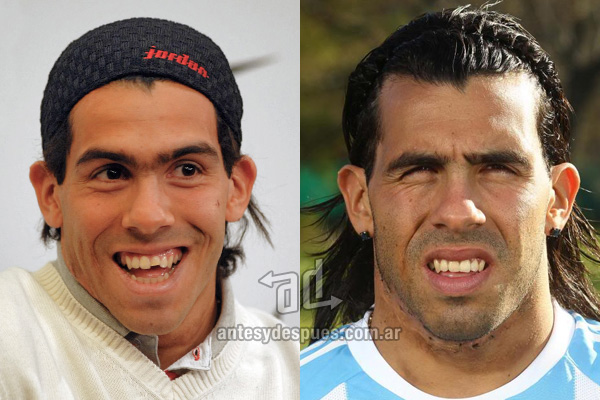 carlos-tevez_dientes_antesydespues.com.ar