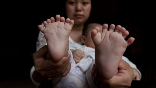 En China nació un bebé con 31 dedos y sus padres piden ayuda