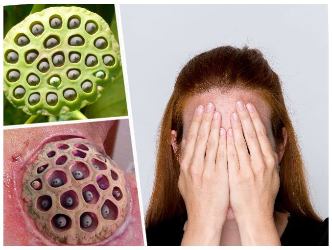 ¿Sientes asco al ver ciertas imágenes? Descubre si tienes esta insólita pero común fobia