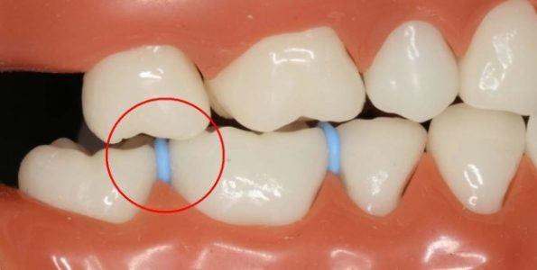 21 cosas que siempre recordarán las personas que usaron brackets