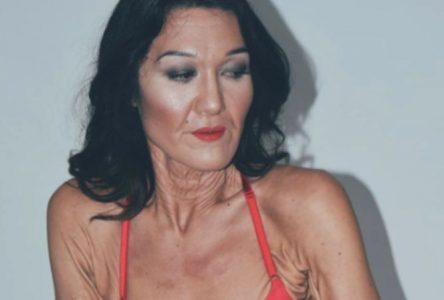 Esta mujer con 26 años y con una rara condición en su piel esta cambiando las normas de belleza