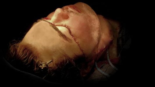 Paciente de 26 años de edad con rostro trasplantado, revela cara nueva
